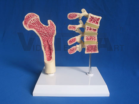 Hip and vertebrae with osteoporosis